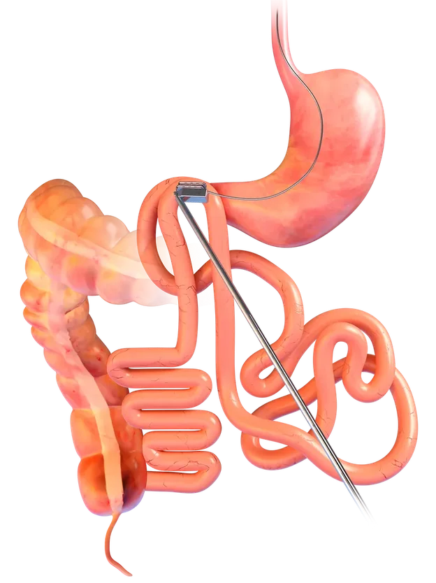 Illustration of the digestive system, with the two small magnets meeting through the wall of the gut