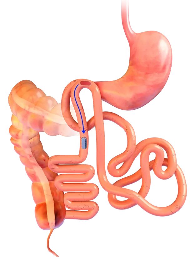 Illustration of the magnets, still joined, moving on through the intestine after the new path has formed